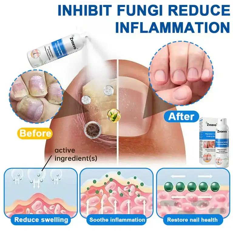 Zvoevo®Magnesium Herbal Psoriasis Spray Zvoevo®Magnesium Herbal Psoriasis Spray