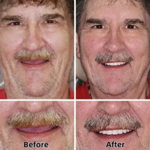 SmileFitPro™-Advanced Custom-Fit Functional Dentures SmileFitPro™-Advanced Custom-Fit Functional Dentures