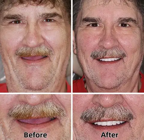 SmileFitPro™-Advanced Custom-Fit Functional Dentures SmileFitPro™-Advanced Custom-Fit Functional Dentures