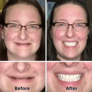 SmileFitPro™-Advanced Custom-Fit Functional Dentures SmileFitPro™-Advanced Custom-Fit Functional Dentures