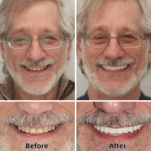 SmileFitPro™-Advanced Custom-Fit Functional Dentures SmileFitPro™-Advanced Custom-Fit Functional Dentures