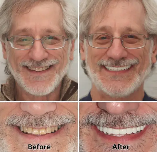SmileFitPro™-Advanced Custom-Fit Functional Dentures SmileFitPro™-Advanced Custom-Fit Functional Dentures