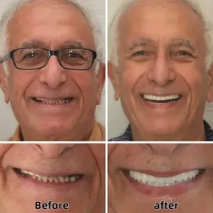 ROLOPL™ Custom Functional Denture Kits ROLOPL™ Custom Functional Denture Kits